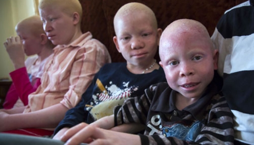 Bodies of Tanzanian albinos are more expensive than gold (Photo)